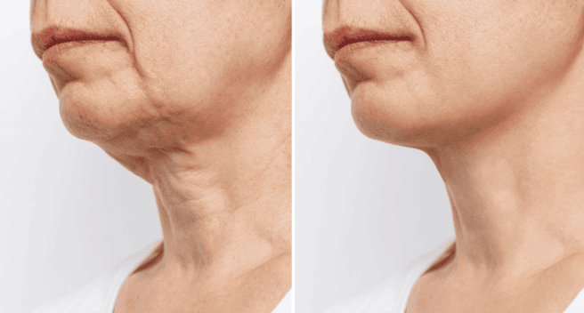 Facelifting bei MerhaBeauty in der Türkei Facelifting bei MerhaBeauty in der Türkei