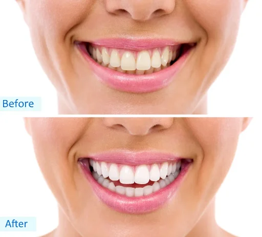 Zahnaufhellung/ Bleaching bei MerhaBeauty