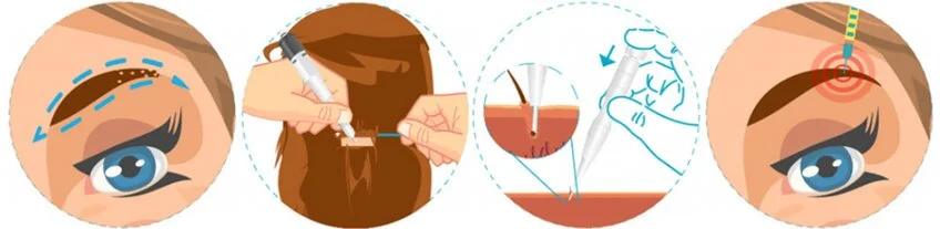 Augenbrauentransplantation 1 Antalya Merhabeauty Augenbrauentransplantation 1 Antalya Merhabeauty