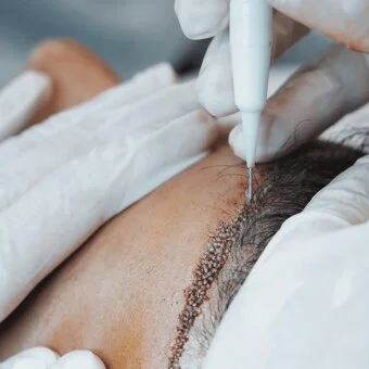 Wie läuft die Eigenhaartransplantation mit der FUE Methode ab?