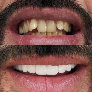 All on 4 MerhabBeauty vorher - nachher 4