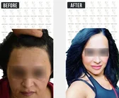 Haartransplantation Vorher-Nachher MerhaBeauty