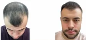 Haartransplantation Vorher-Nachher MerhaBeauty