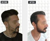 Haartransplantation Vorher-Nachher MerhaBeauty