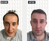 Haartransplantation Vorher-Nachher MerhaBeauty