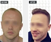 Haartransplantation Vorher-Nachher MerhaBeauty