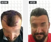 Haartransplantation Vorher-Nachher MerhaBeauty