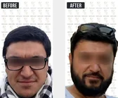 Haartransplantation Vorher-Nachher MerhaBeauty