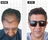 Haartransplantation Vorher-Nachher MerhaBeauty