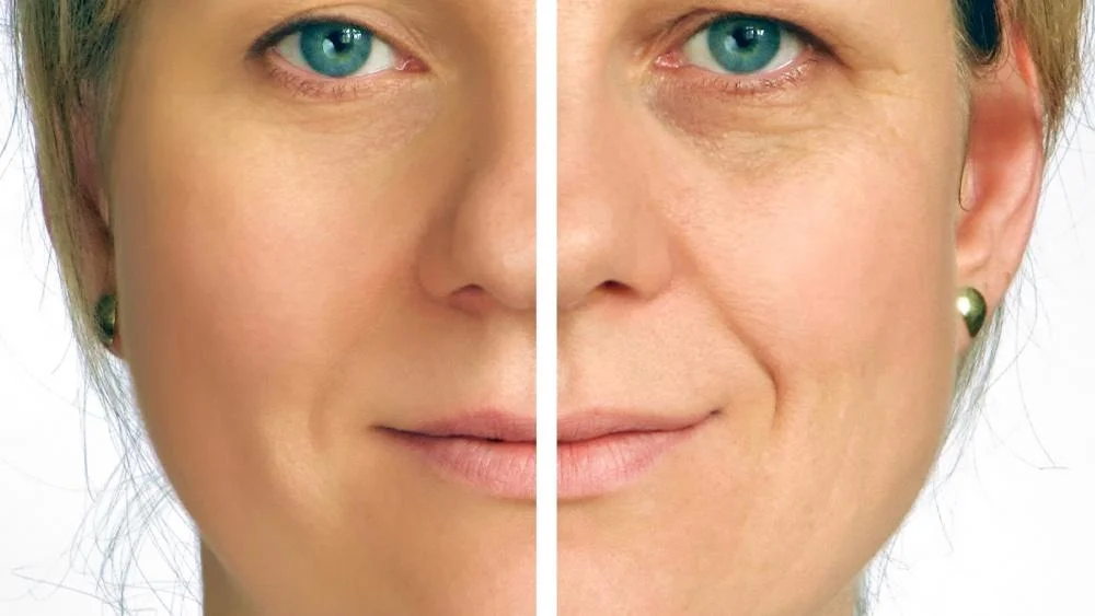 Facelifting bei MerhaBeauty in der Türkei Facelifting bei MerhaBeauty in der Türkei