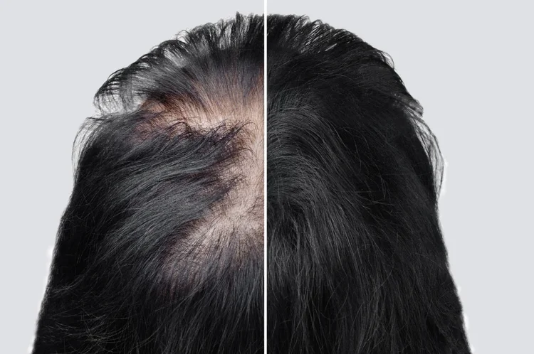 Haartransplantation für Frauen in der Türkei bei Merhabeauty