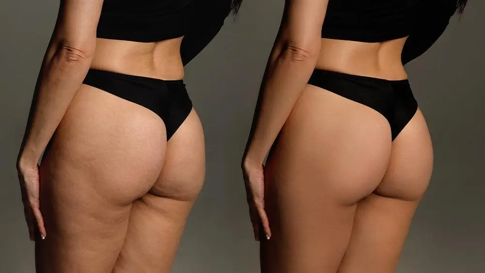 Postraffung oder Gesäßlifting MerhaBeauty Postraffung oder Gesäßlifting MerhaBeauty