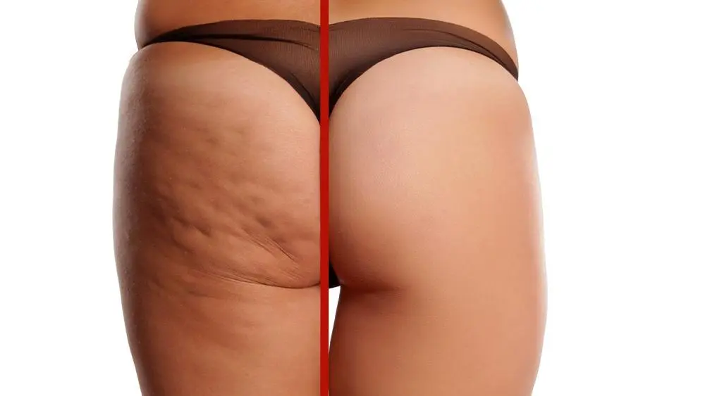 Postraffung oder Gesäßlifting MerhaBeauty Postraffung oder Gesäßlifting MerhaBeauty