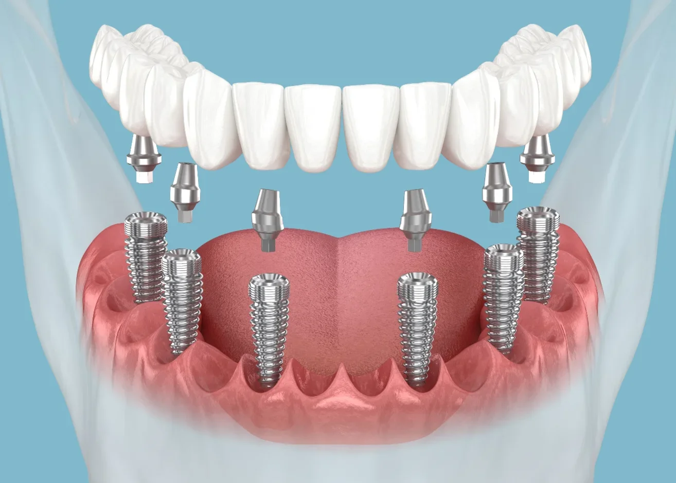 All on 6 Implantat MerhaBeauty