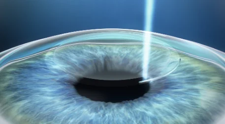 Femto Lasik Merhabeauty